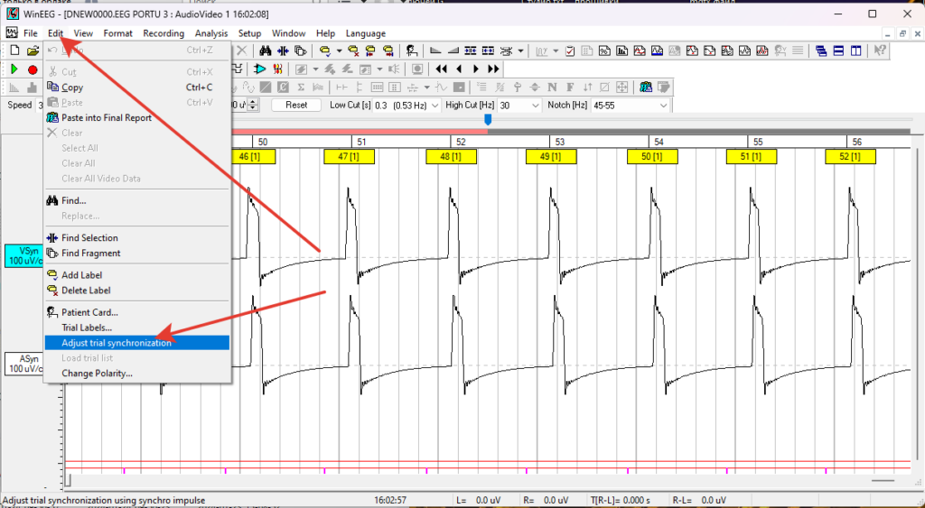 WinEEG program will record the signal from the synchronizing mark from the screen VSyn ASyn